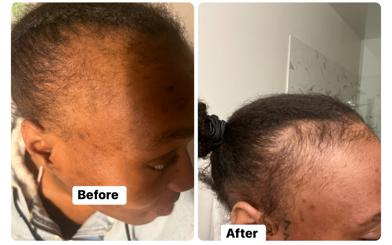 The Root Booster Hair Growth Shot – Extreme Concentrate